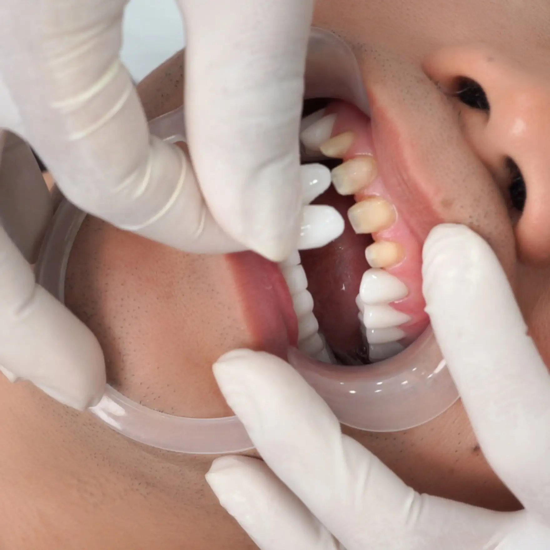 Gắn răng sứ chính thức sau khi đã đảm bảo chuẩn thẩm mỹ và chức năng